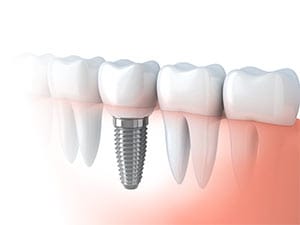 Graphic image of Dental implant
