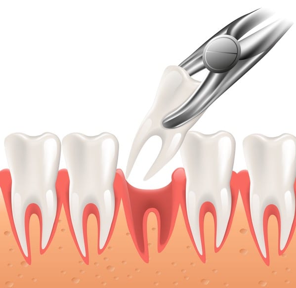 Graphic image of tooth extractions