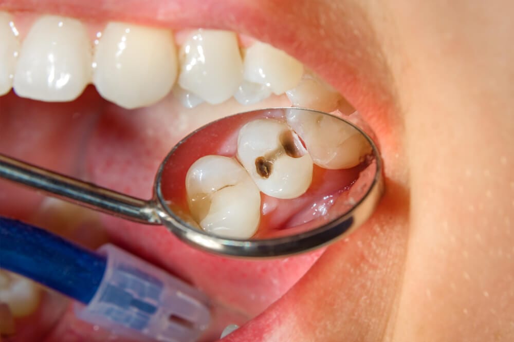 A picture showing a teeth that needs composite fillings