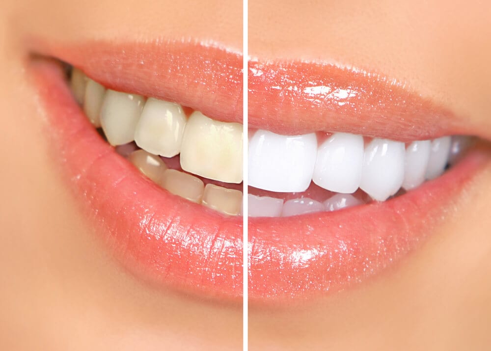 Before and after Teeth Whitening procedure